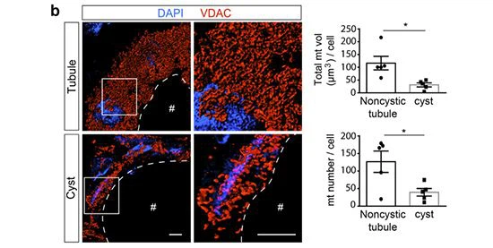 figure 7-polycystic kidney disease figure 7-polycystic kidney disease